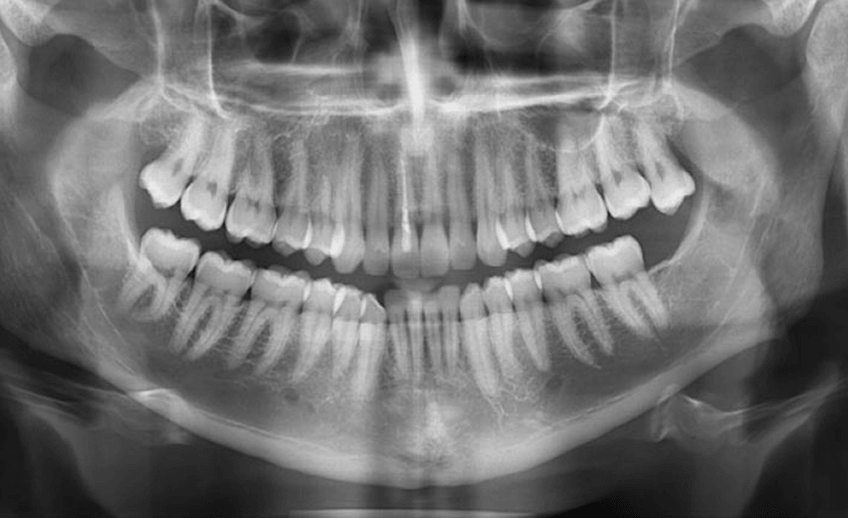 Где сделать панорамный снимок. Транспозиция зубов рентген. Панорамный снимок зубов излучение. Расстановка зубов рентген.